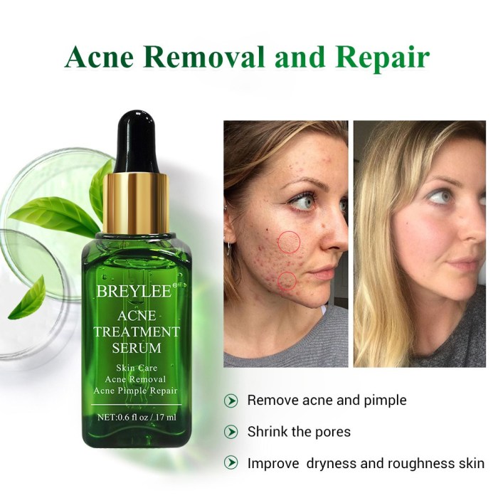 acne cream anti treatment removal pores moisturizing 20g shrink pimple spots control oil face serum skin care