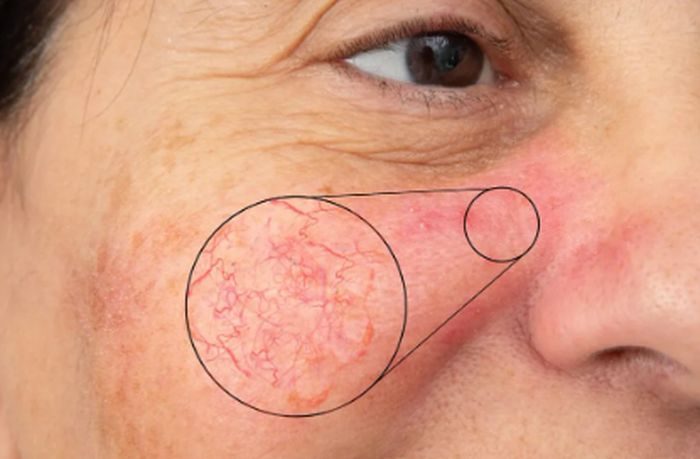 Ilustrasi spider veins di wajah