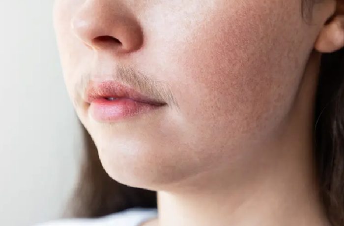 Ilustrasi hipertrikosis//www.webmd.com