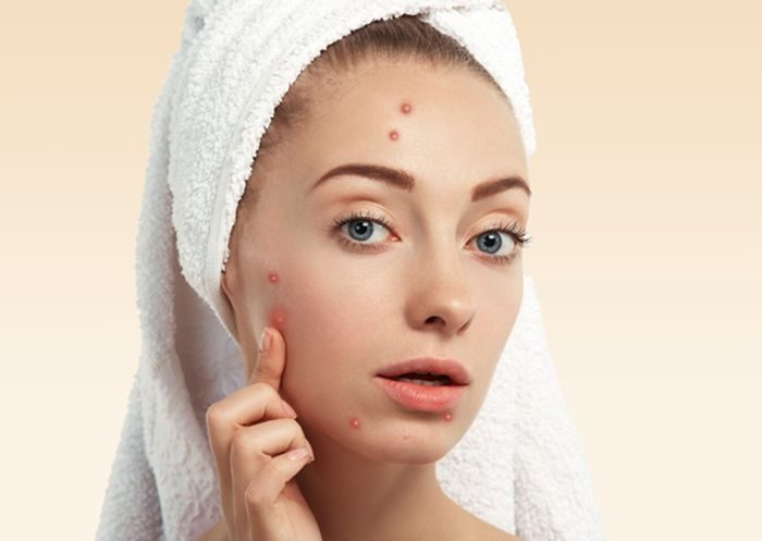 Ilustrasi jerawat steroid/Freepik: wayhomestudio