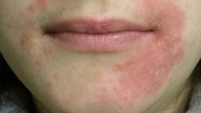 Ilustrasi ruam sekitar mulut