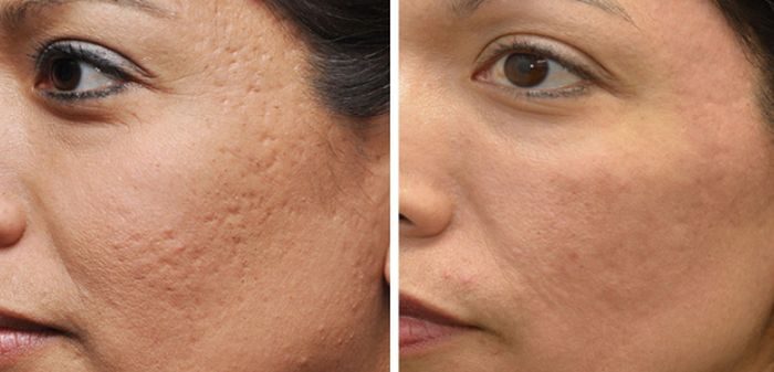 Ilustrasi stretch mark