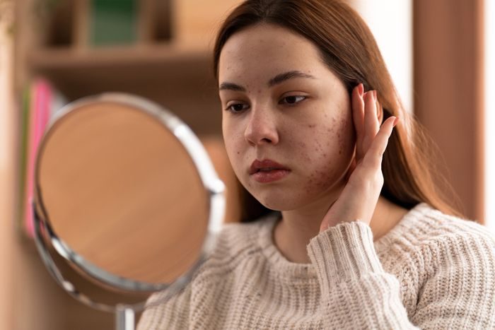 Munculnya jerawat telah dikaitkan dengan peningkatan tingkat stres. Hormon stres meningkatkan aktivitas androgen, yang merangsang kelenjar sebaceous untuk menyebabkan produksi sebum berlebih. Munculnya jerawat telah dikaitkan dengan peningkatan tingkat stres. Hormon stres meningkatkan aktivitas androgen, yang merangsang kelenjar sebaceous untuk menyebabkan produksi sebum berlebih.