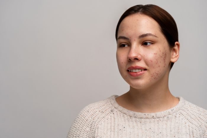 Penumpukan sel kulit mati yang nggak normal/foto: freepik.com Penumpukan sel kulit mati yang nggak normal/foto: freepik.com