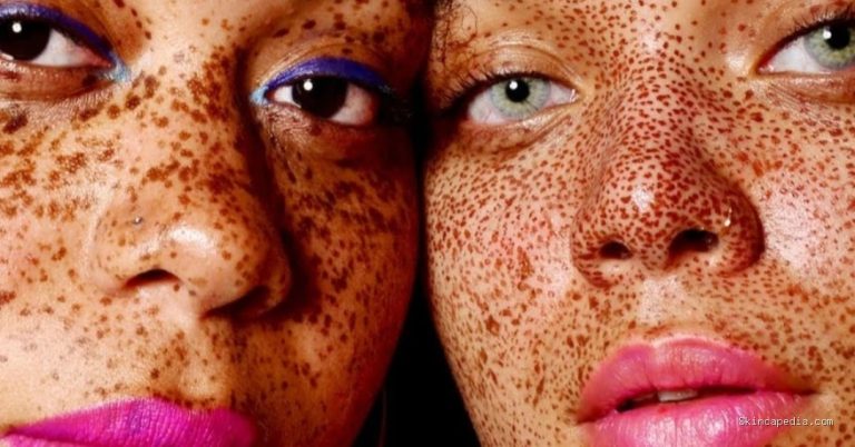 Flek Hitam Hilang: Mitos atau Fakta? Ini Penjelasannya