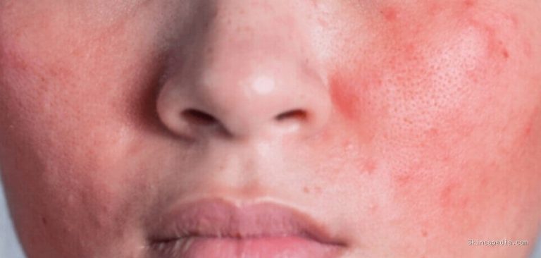 Rekomendasi Moisturizer Terbaik untuk Skin Barrier Anda: Rahasia Kulit Sehat