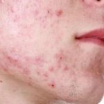 Rekomendasi Skincare yang aman untuk kulit oily + Acne prone Skin
