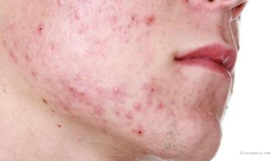 Rekomendasi Skincare yang aman untuk kulit oily + Acne prone Skin