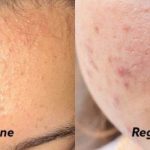 Skincare Fungal Acne Aman & Terjangkau: Rekomendasi Terbaik