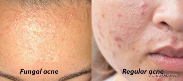 Skincare Fungal Acne Aman & Terjangkau: Rekomendasi Terbaik