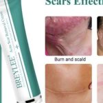 Breylee Acne Scar Removal Cream: Cek Ingredients Rahasia Wajah Mulus