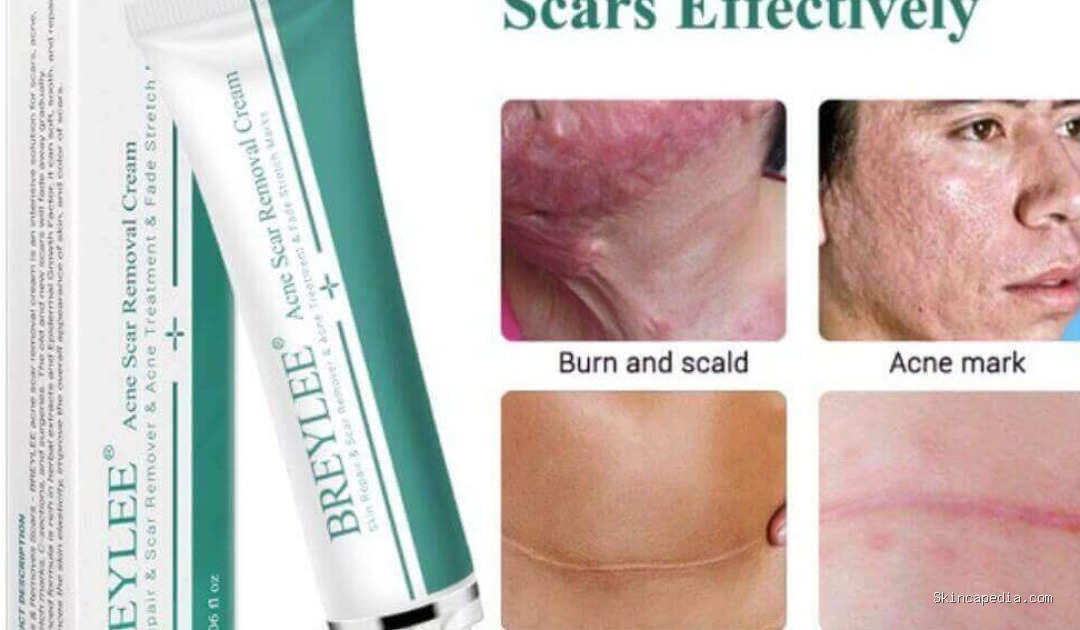Breylee Acne Scar Removal Cream: Cek Ingredients Rahasia Wajah Mulus