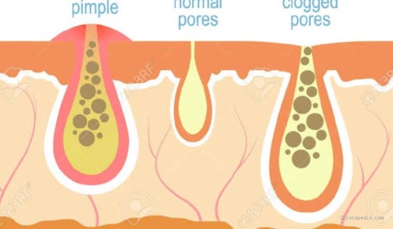 Rating Komedogenik: Akurat atau Sekadar Mitos?