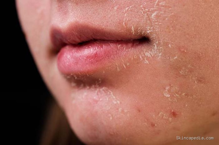 Photo via Bing Images - Penyebab Wajah Mengelupas Meski Sudah Rutin Pakai Moisturizer