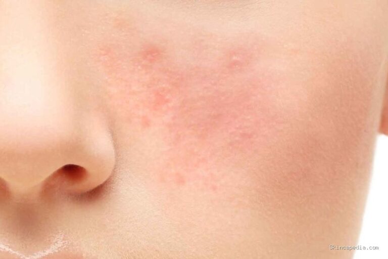 Photo via Bing Images - Penyebab Wajah Merah Setelah Pakai Skincare dan Cara Mengatasinya