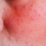 Photo by diary.marshabeauty.com - Efek Memakai Skincare Asam AHA Saat Kulit Sedang Terbakar Matahari