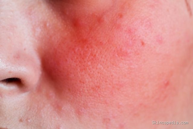 Photo by diary.marshabeauty.com - Efek Memakai Skincare Asam AHA Saat Kulit Sedang Terbakar Matahari