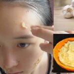 Photo by karinatarocannon.blogspot.com - Manfaat Bawang Putih untuk Jerawat: Efektivitas dan Efek Samping