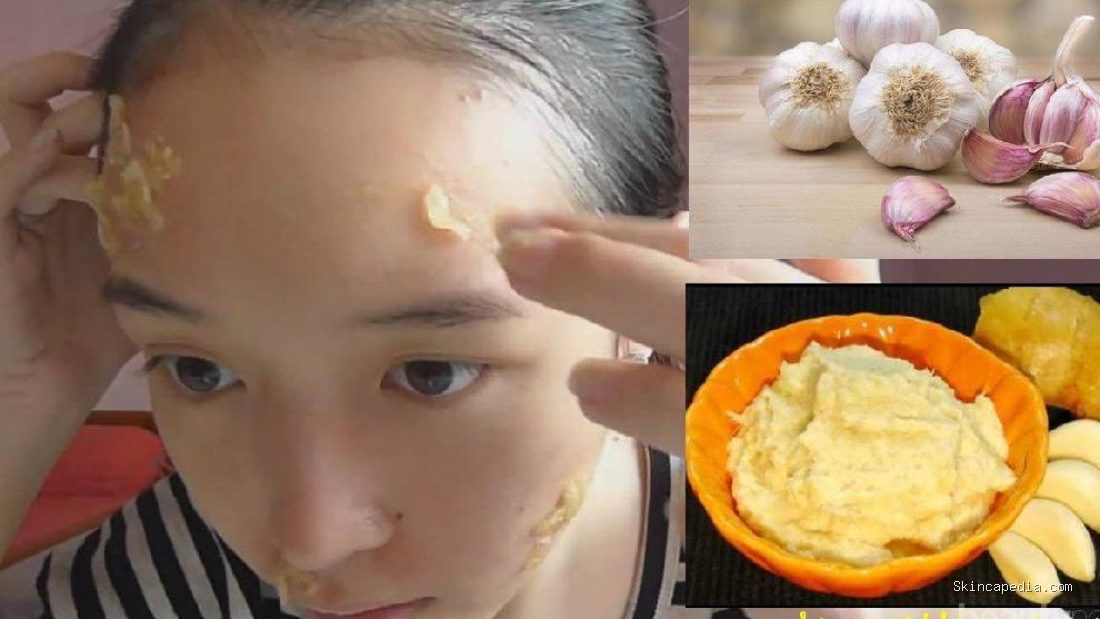 Photo by karinatarocannon.blogspot.com - Manfaat Bawang Putih untuk Jerawat: Efektivitas dan Efek Samping