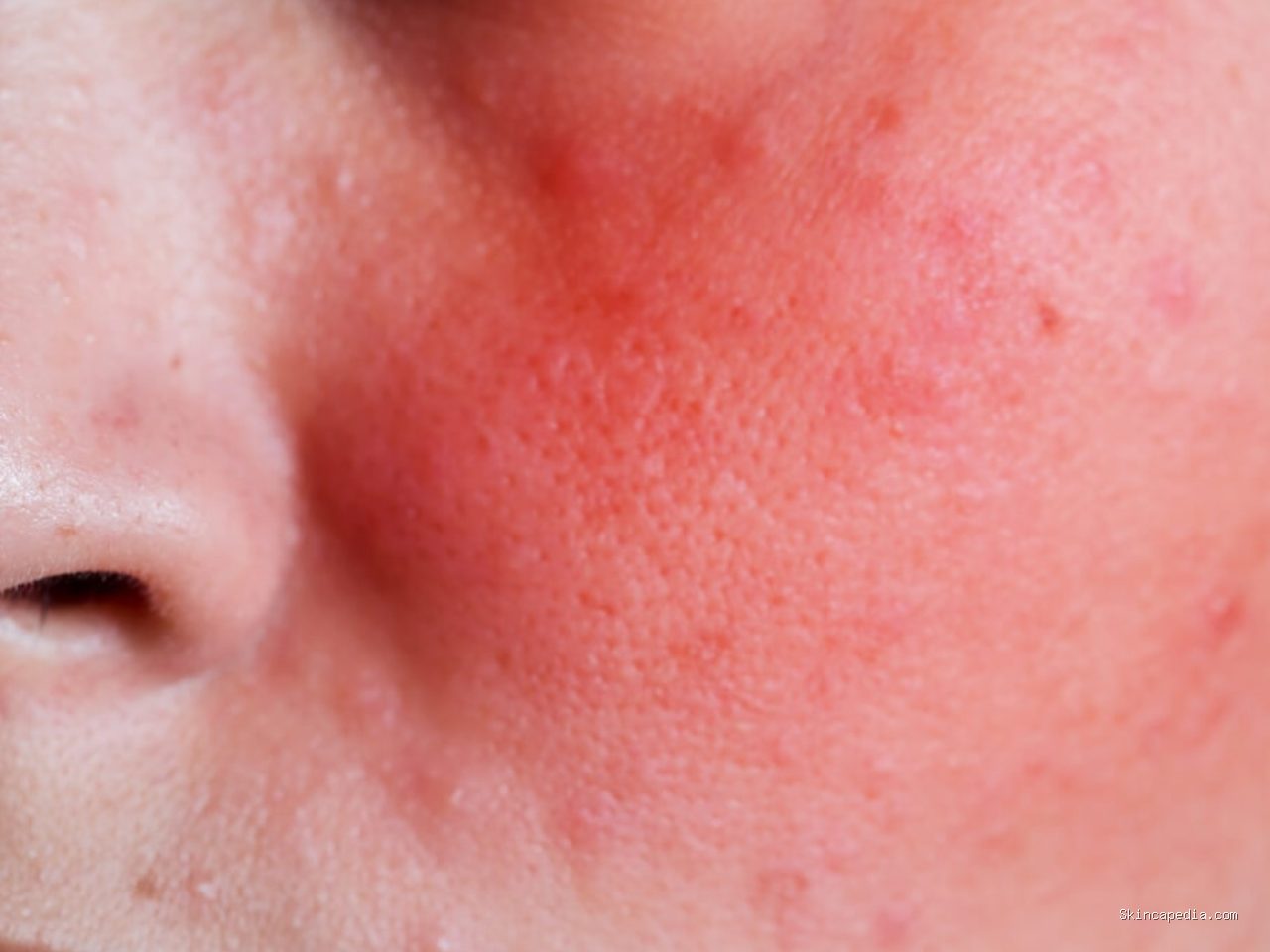 Tanda Skin Barrier Rusak Akibat Eksfoliasi Berlebihan Tiap Malam