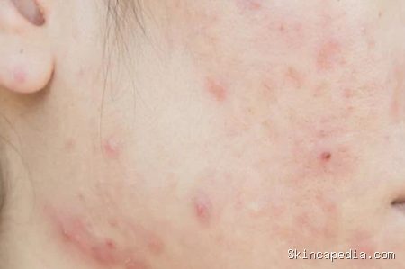 Tanda Skin Barrier Rusak Akibat Eksfoliasi Berlebihan Tiap Malam