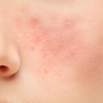Photo by evamuliaclinic.com - Tanda Skin Barrier Rusak Akibat Eksfoliasi Berlebihan Tiap Malam